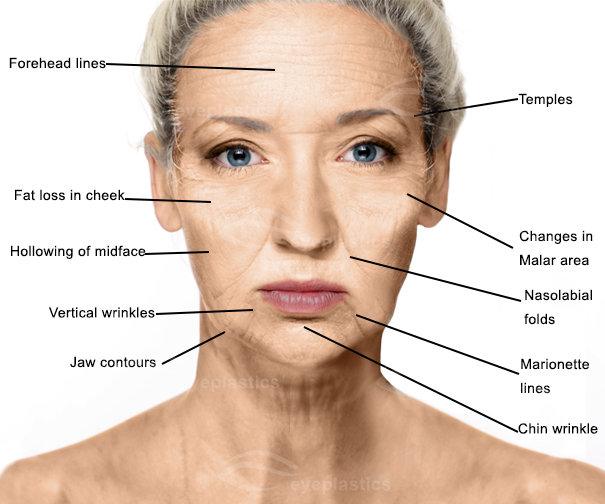 Aging Face | mid face aging face | Face lift | Facelift